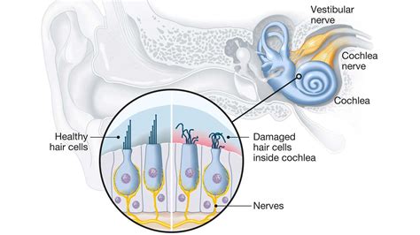 meningitis causes hearing loss